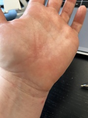 Is this actually dermatitis? Sooooo itchy!