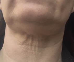 Crepe neck help!