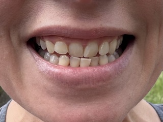 Adult braces - experience