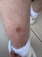 What is this on partners leg?