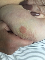 Scared it might be inflammatory breast cancer