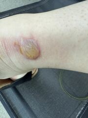 Need advise- am I worrying too much (disgusting photo alert)