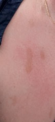rash on neck and face does anyone know what this is
