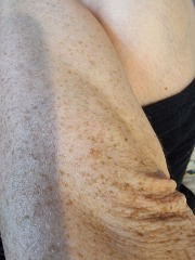 Does this look like skin cancer?