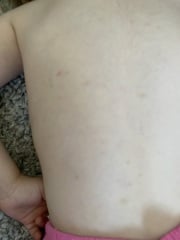 Impetigo? Or something else? Currently pregnant and anxious