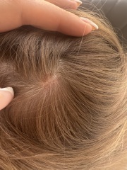 Cradle cap in 6 year old
