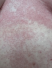 Rash pics!