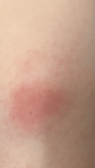 Immunisation reaction?