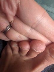 Toenails falling off and bulbus tip (pics attached)