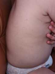 Does this look like chicken pox?