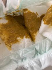 Could this possibly be CMPA? *TMI picture of baby poo