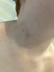 Mark on Childs neck
