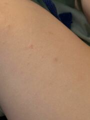Is This Chicken Pox?