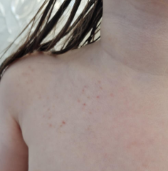 Does this look like a heat rash?