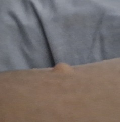 What's this lump I now have??