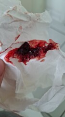 Miscarriage but stronger positive tests??