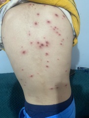 38 weeks pregnant and think DS has chickenpox