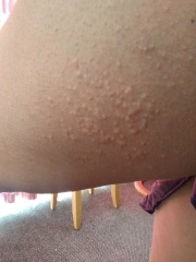 To wonder wtf this raised itchy rash is that I've had for 48 hours?