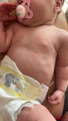 Baby acne or CMPA rash