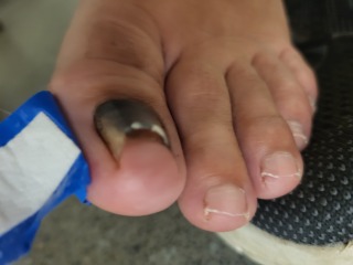 Will they remove my toenail?