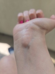 Lump in the inside inner part of wrist
