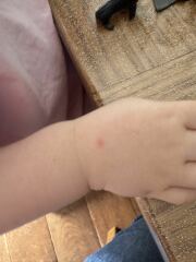 Is This Chicken Pox?