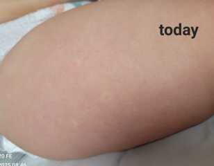 What are these spots on toddler?