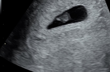 6 weeks scan feel like im pregnant with twins but scan shows 1 baby