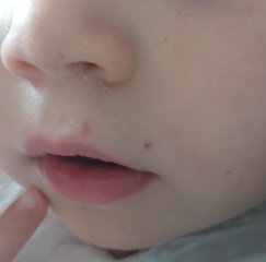 Is this a coldsore on my toddler?