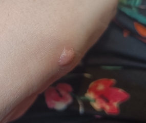 Is this a wart or should I see a doctor?