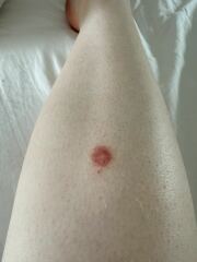 Is this ringworm on leg?