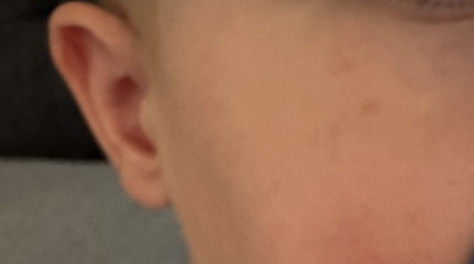 Chicken pox