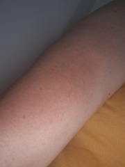 What is this rash on my arm