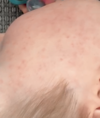 Roseola or stomach virus?