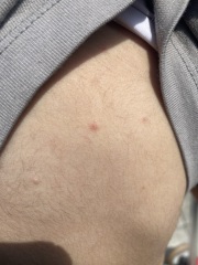 38 weeks pregnant and think DS has chickenpox