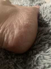 What really works for dry heels