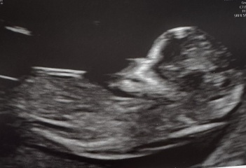 Boy or girl