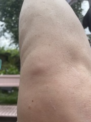 Lump under knee