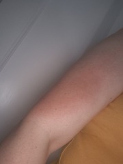 What is this rash on my arm