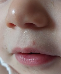 Is this a coldsore on my toddler?