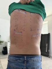 Skin patch testing … ( photo ) anyone have input ?