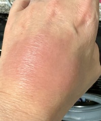 Unexplained  swelling back of  (L) hand