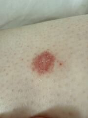 Is this ringworm on leg?