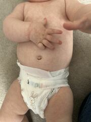 Anyone know what this rash is in my baby (pic)
