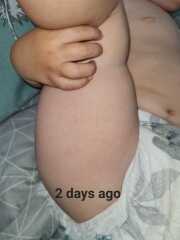 What are these spots on toddler?