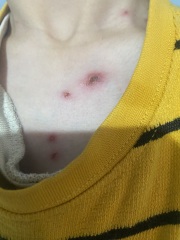 38 weeks pregnant and think DS has chickenpox