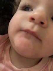 Cut that turned into a white blister?