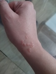 Possible psoriatic arthritis- any early experiences?