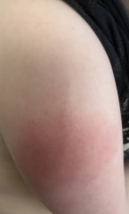 Immunisation reaction?