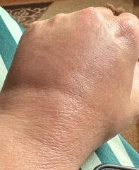 Unexplained  swelling back of  (L) hand